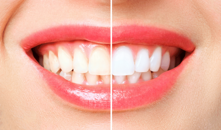 diş-beyazlatma